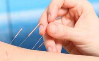 Иглы для похудения вред