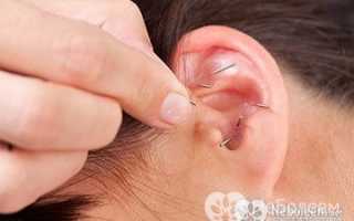 Иголки для похудения все