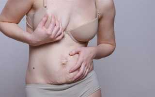 Как восстановить обвисший живот после похудения