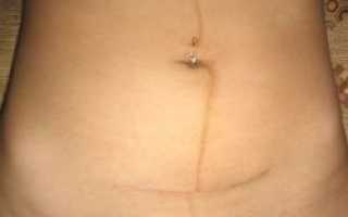 Обертывания для похудения живота после кесарева сечения