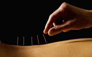 Не похудела после иглоукалывания