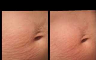 Видны ли растяжки после похудения