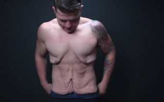 Отвисшая кожа после похудения операция