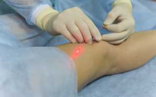 Влок внутривенное лазерное облучение крови для похудения