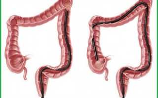 Как называется процедура для похудения клизма